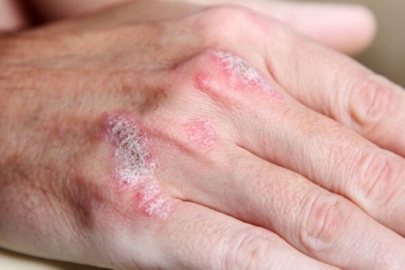 Psoriasis-Symptome an den Händen