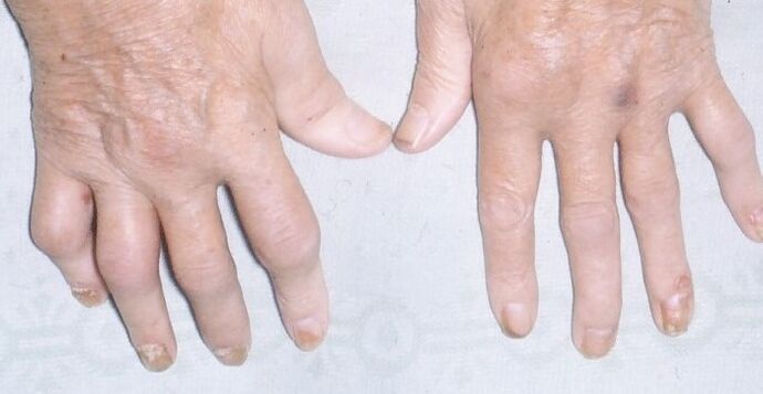 arthropathische Psoriasis an den Händen
