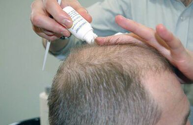 Psoriasis-Behandlung der Kopfhaut