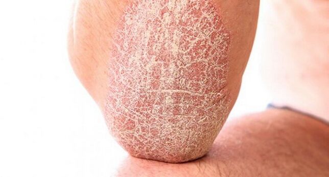 Psoriasis vulgaris auf der Haut