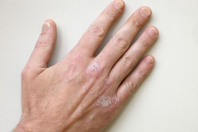 Ein obligatorisches Symptom der Psoriasis sind Plaques mit Schuppen auf der Haut