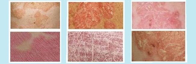 Hautausschläge, die für verschiedene Arten von Psoriasis charakteristisch sind