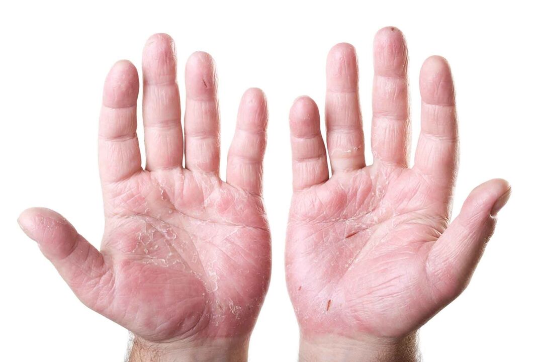 Arten von Psoriasis an den Handflächen