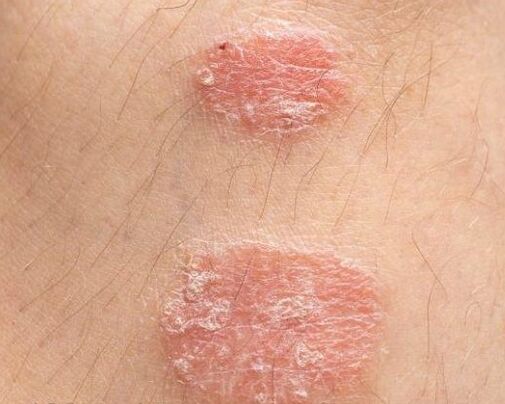 Aussehen von Psoriasis Plaques
