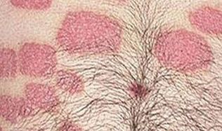 Mehrere rosa Formationen am Bauch