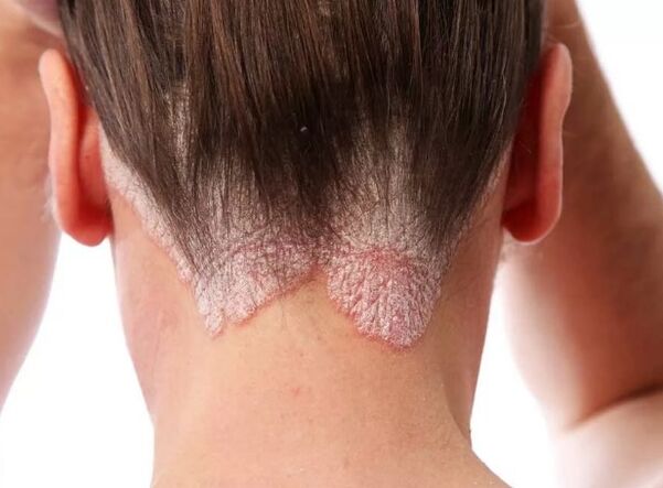 Psoriatische Erythrodermie
