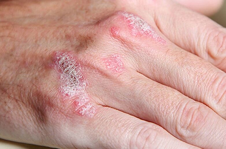 Ladomarisch bedarfswerte Psoriasis