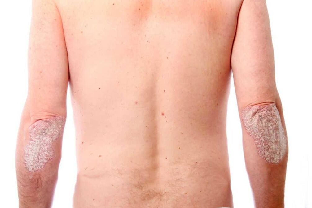 Die zweite Stufe der Psoriasis