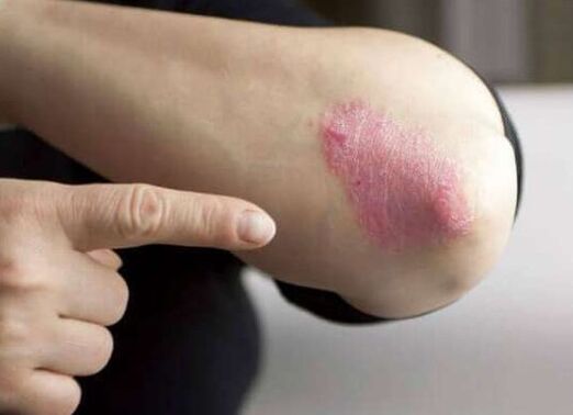 Die stationäre Stufe der Psoriasis