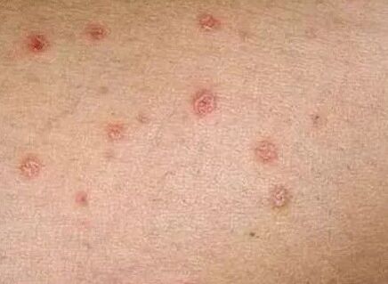 Psoriasis des Anfangsstadiums