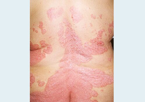 Psoriasis des Rückens