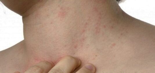 Psoriasis am Hals