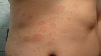 Psoriasis auf dem Magen