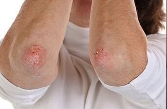 Psoriasis auf den Ellbogen