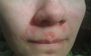 Psoriasis im Gesicht