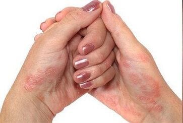 Psoriasis in den Händen