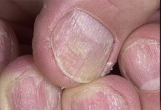Psoriasis von Nägeln