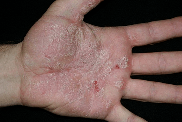 Psoriasis in den Händen
