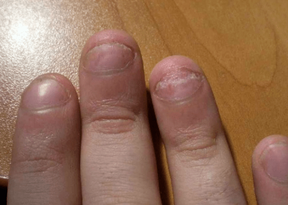 Psoriasis von Nägeln