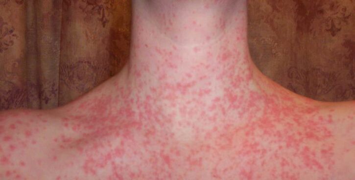 Psoriasis am Körper