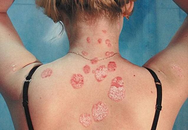 Psoriasis auf dem Rücken