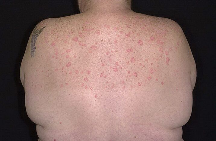 Psoriasis auf den Schultern