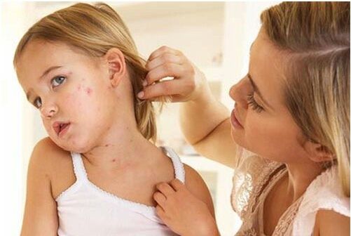 Foto der Anfangsphase der Psoriasis