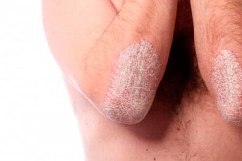 Psoriasis an den Ellenbogen