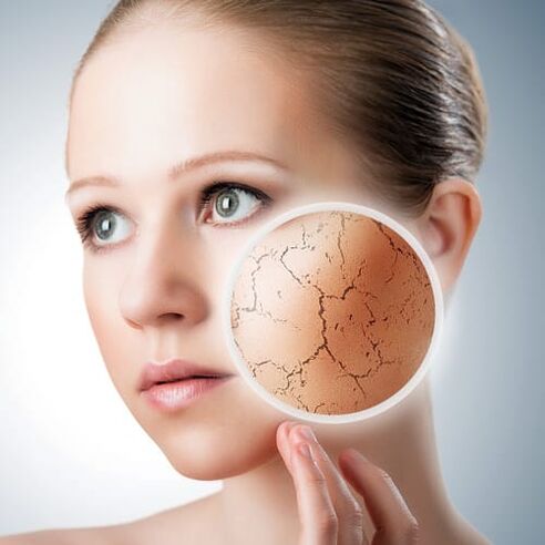 Psoriasis im Gesicht
