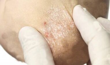 Behandlung von Psoriasis im Abschwächungsstadium