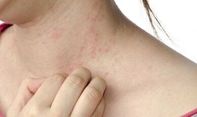 Behandlung von Psoriasis im fortgeschrittenen Stadium