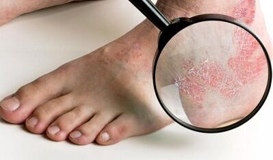 Möglichkeiten zur Behandlung von Psoriasis