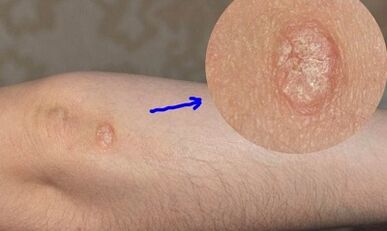 Stadien der Psoriasis-Entwicklung
