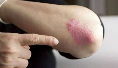 stationäres Stadium der Psoriasis-Entwicklung