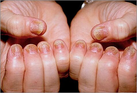 Nagelpsoriasis