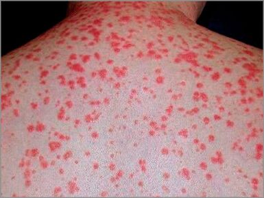 Psoriasis guttata