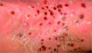 Pustelpsoriasis
