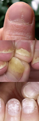 Nagelpsoriasis - Anfangsstadium