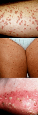 Psoriasis auf den Beinen