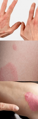 Psoriasis der Anfangsphase in den Händen