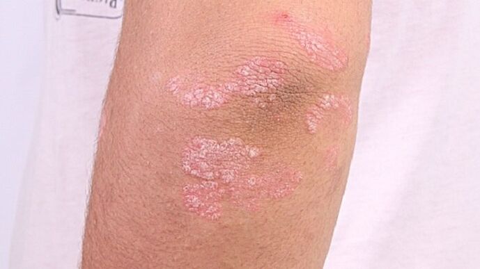 Foto einer Psoriasis im Frühstadium