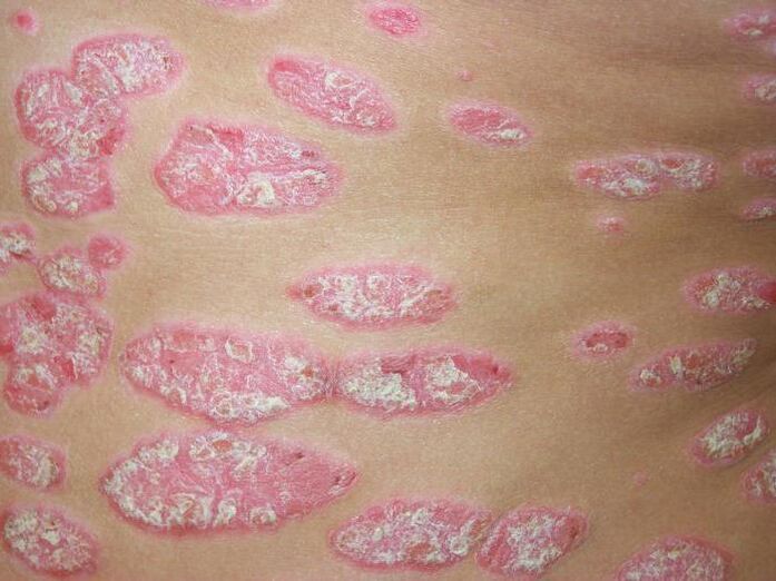 Plaque-Psoriasis