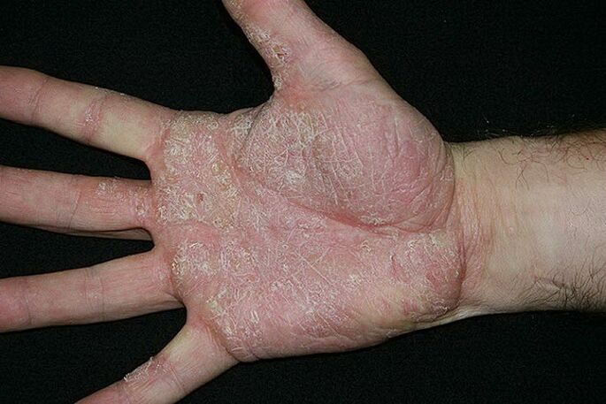 Psoriasis der Handflächen und Füße