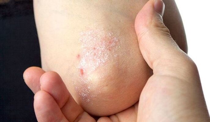 Symptome einer Psoriasis im Anfangsstadium