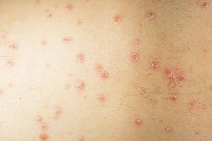 Symptome einer fleckförmigen Psoriasis