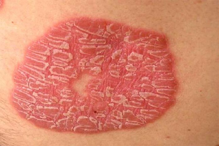 pustulöse Psoriasis