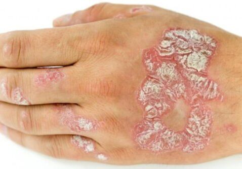 Psoriasis zur Hand