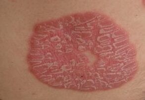 Fotos von Psoriasis auf der Haut