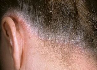 Ursachen der Psoriasis am Kopf