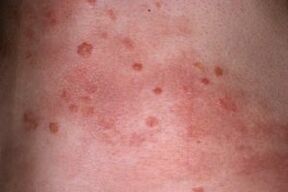 Foto von Psoriasis auf der Haut